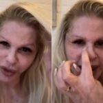 Monique Evans comemora evolução do rosto sete dias após cirurgia plástica